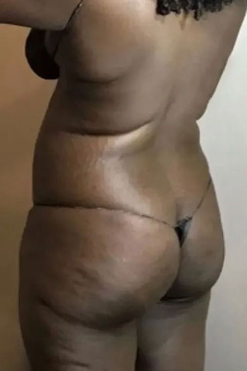 Real patient Brazilian Butt Lift before photo