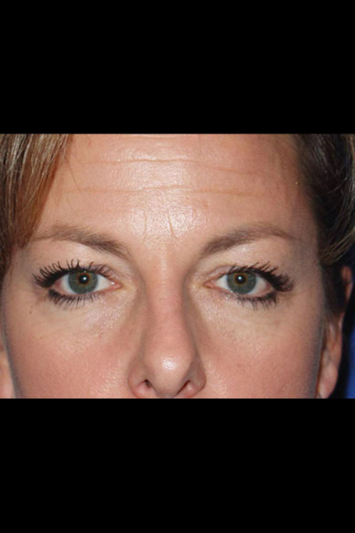 Real patient Eyelid Surgery before photo