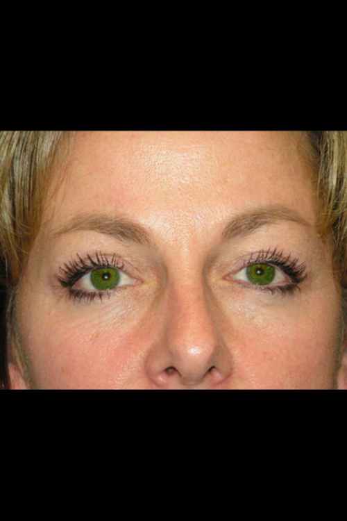 Real patient Eyelid Surgery after photo