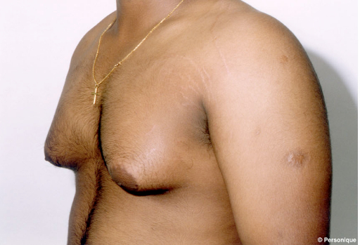 Real patient Gynecomastia before photo