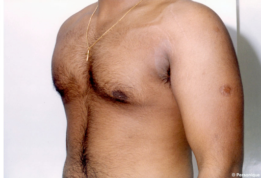 Real patient Gynecomastica after photo