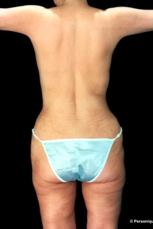 Liposuction - Body