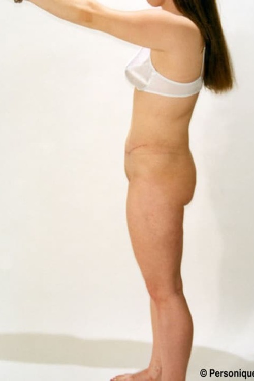 Liposuction - Body