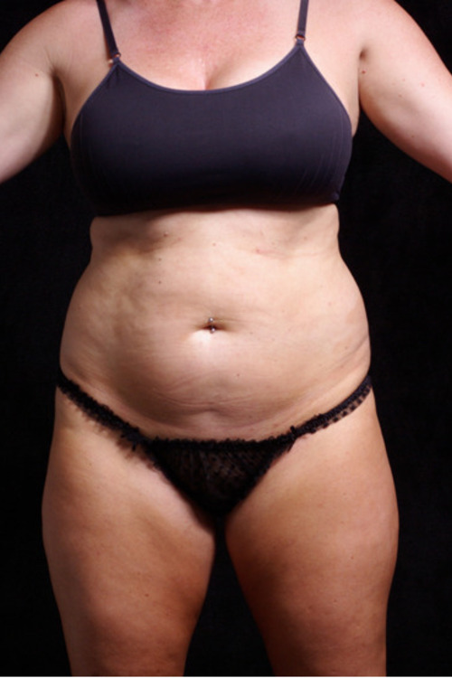 Real patient Body Liposuction before photo