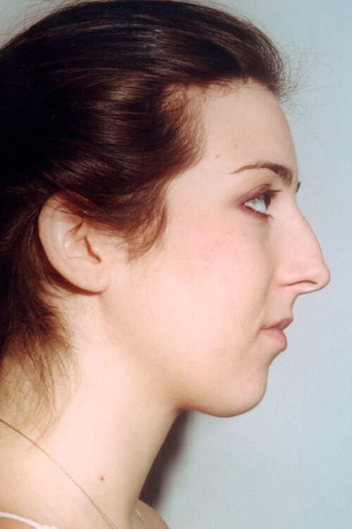 Neck & Face Liposuction