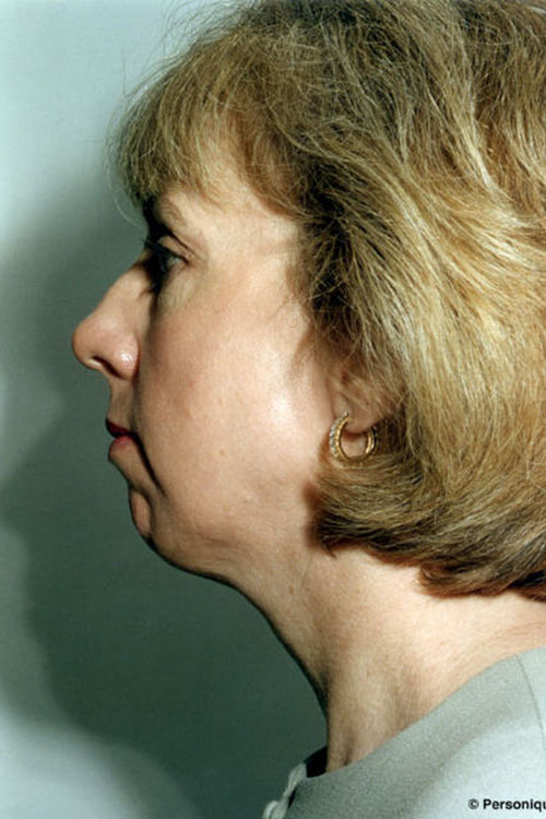 Real patient Neck Liposuction / Neck Lift before photo