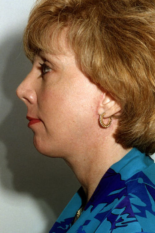Real patient Neck Liposuction / Neck Lift after photo