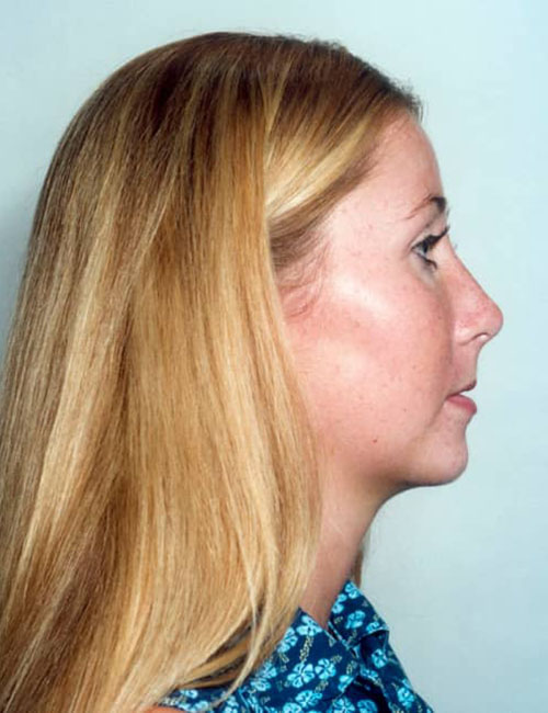 Neck & Face Liposuction