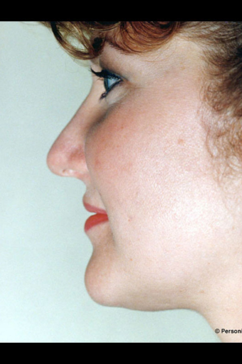 Real patient Rhinoplasty after photo