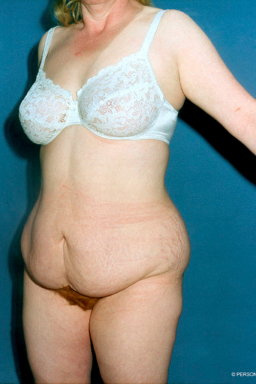 Real patient Tummy Tuck before photo